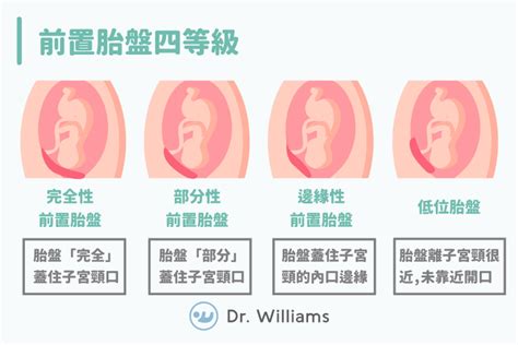 前置胎盤剝離|前置胎盤一點也不可怕！讓醫師教妳平時怎麼做！ 